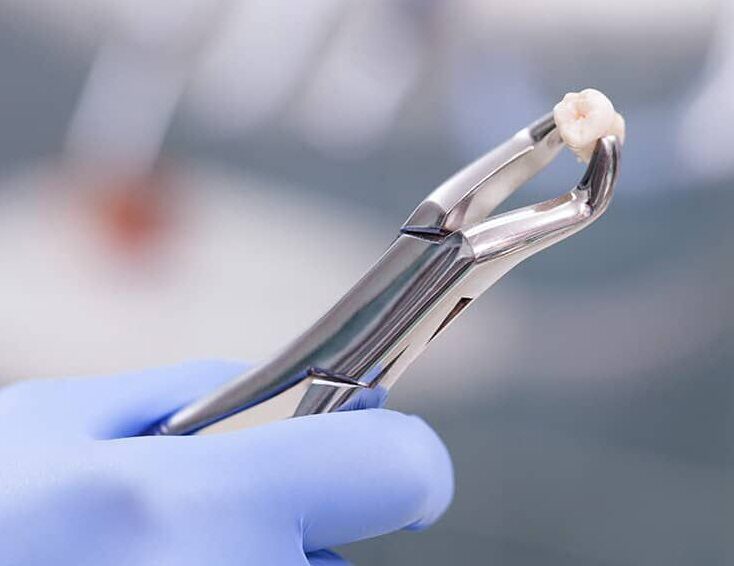 Tooth Extraction