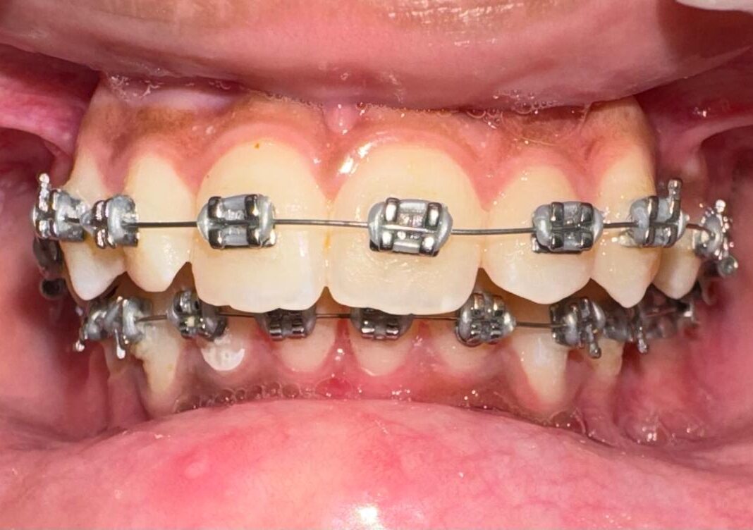 Teeth Braces