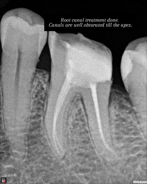 RootCanal Treatment